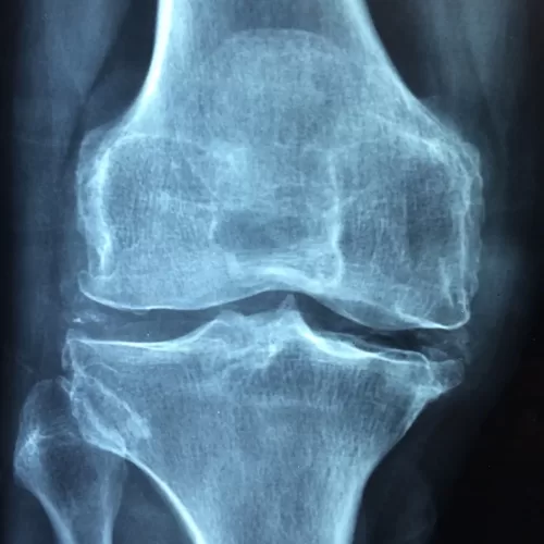knee-1406964_1920.jpg knee-1406964_1920.jpg